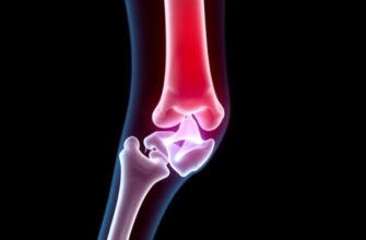 Перелом шейки бедра: как лечиться и восстановиться так, чтобы вернуться к жизни